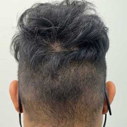 Hair Restoration Before & After Patient #2766