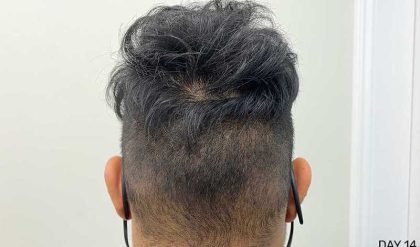 Hair Restoration Before & After Patient #2766