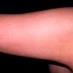 Liposuction Before & After Patient #2844