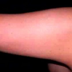 Liposuction Before & After Patient #2844