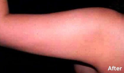 Liposuction Before & After Patient #2844