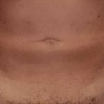 Liposuction Male Before & After Patient #2903