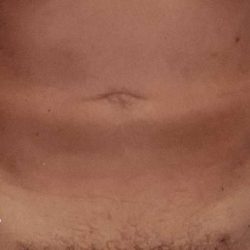 Liposuction Male Before & After Patient #2903