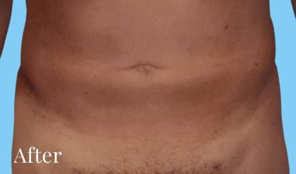Liposuction Male Before & After Patient #2903