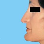 Rhinoplasty Before & After Patient #2976