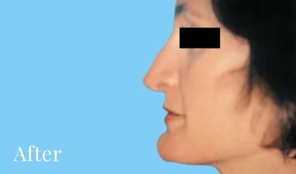 Rhinoplasty Before & After Patient #2976