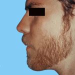 Rhinoplasty Male Before & After Patient #3024
