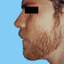 Rhinoplasty Male Before & After Patient #3024
