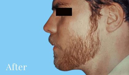 Rhinoplasty Male Before & After Patient #3024