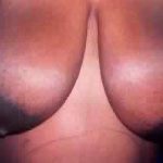Breast Reduction Before & After Patient #2332