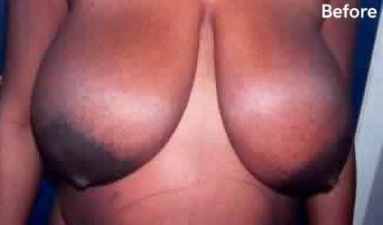Breast Reduction Before & After Patient #2332