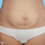 Tummy Tuck Before & After Patient #3063
