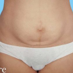 Tummy Tuck Before & After Patient #3063