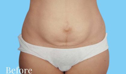 Tummy Tuck Before & After Patient #3063