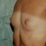 Breast Augmentation Before & After Patient #2222