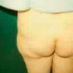 Buttock Augmentation Before & After Patient #2414