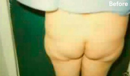 Buttock Augmentation Before & After Patient #2414