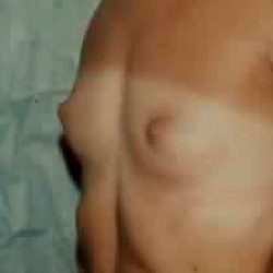 Breast Augmentation Before & After Patient #2222