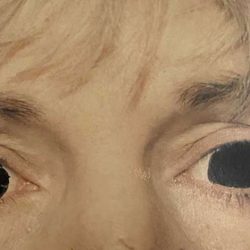 Eyelid Surgery Before & After Patient #2617