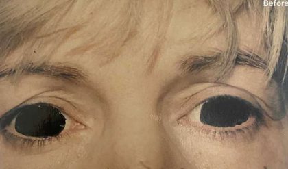 Eyelid Surgery Before & After Patient #2617