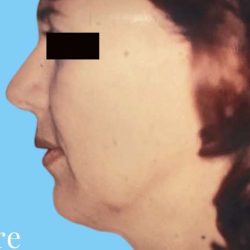 Facelift Before & After Patient #2653