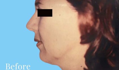 Facelift Before & After Patient #2653
