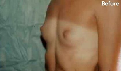 Breast Augmentation Before & After Patient #2222