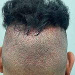 Hair Restoration Before & After Patient #2766