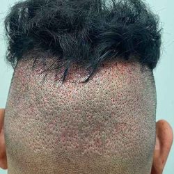 Hair Restoration Before & After Patient #2766