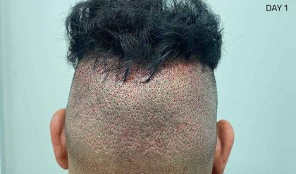 Hair Restoration Before & After Patient #2766