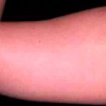 Liposuction Before & After Patient #2844