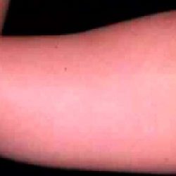 Liposuction Before & After Patient #2844