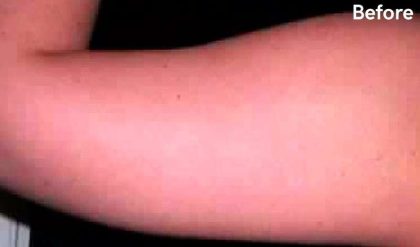 Liposuction Before & After Patient #2844