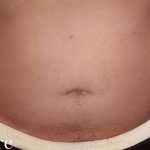 Liposuction Male Before & After Patient #2903