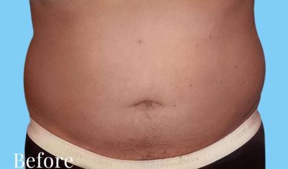 Liposuction Male Before & After Patient #2903