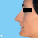 Rhinoplasty Before & After Patient #2976