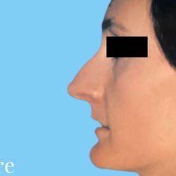 Rhinoplasty Before & After Patient #2976