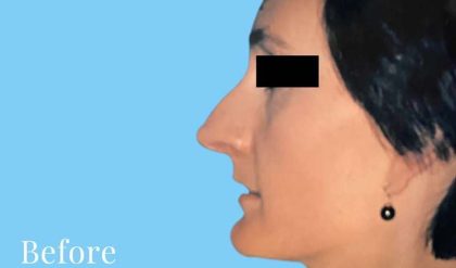 Rhinoplasty Before & After Patient #2976