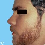 Rhinoplasty Male Before & After Patient #3024
