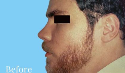 Rhinoplasty Male Before & After Patient #3024