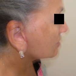 Facelift Before & After Patient #4986
