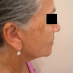 Facelift Before & After Patient #4986