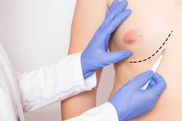 Gynecomastia